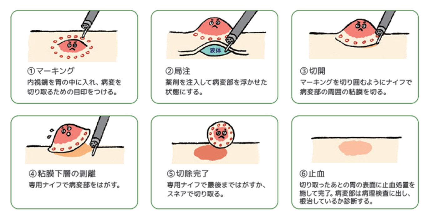 内視鏡治療【ESD】