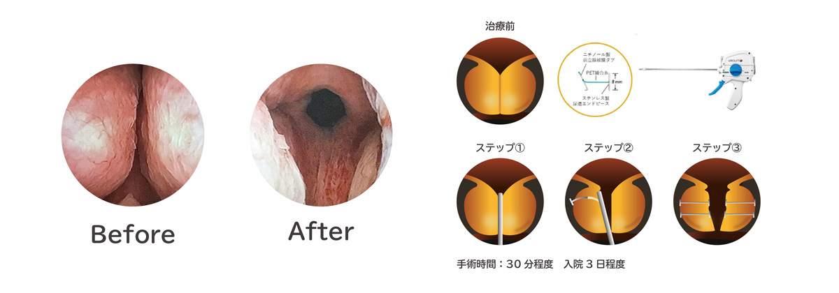 経尿道的前立腺吊り上げ術（ウロリフト）